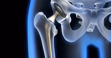 A 3D medical illustration showing a hip joint replacement prosthesis inside a human pelvic bone.